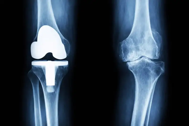 Chirurgia protesica del ginocchio