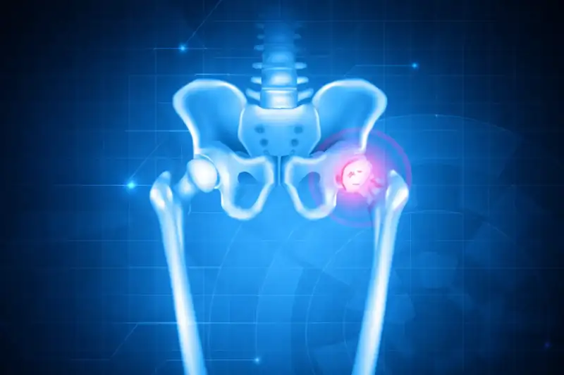 Chirurgia protesica dell'anca